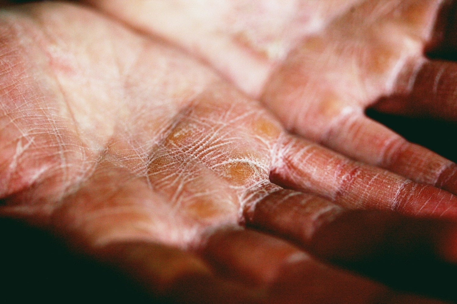 The Missing Link to Your Eczema Flare-Ups - Skynbio Skincare