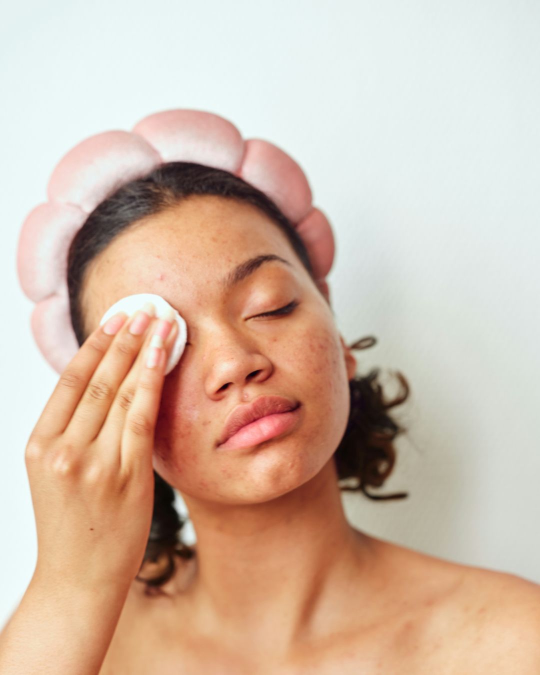 The Problem with Over-Exfoliating for Fungal Acne-Prone Skin - Skynbio Skincare