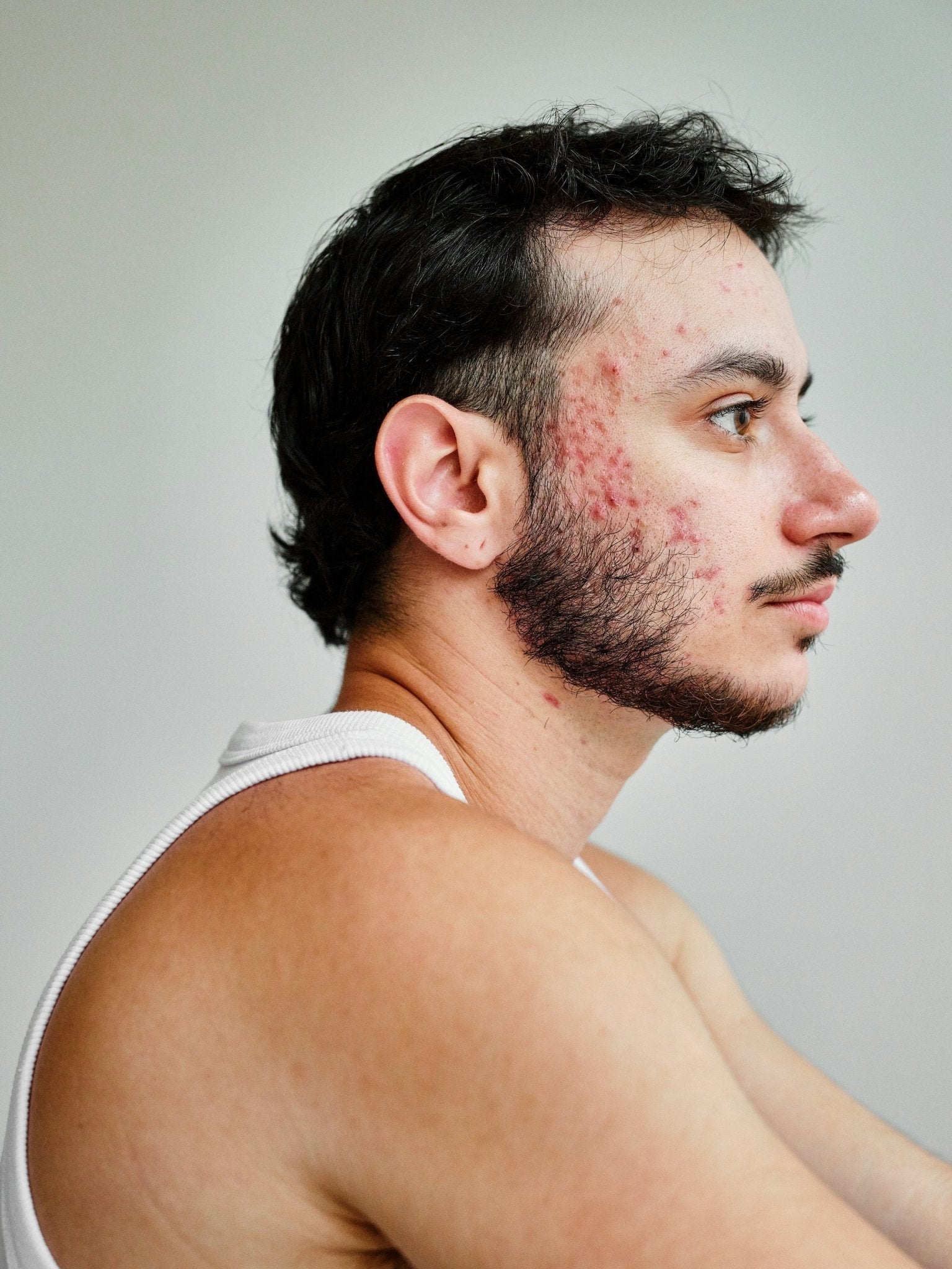 What You Need to Know About Fungal Acne - Skynbio Skincare