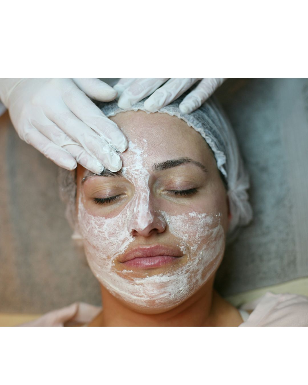 Why Topical Antibiotics and Acne Creams Can Worsen Fungal Acne – Skynbio Skincare