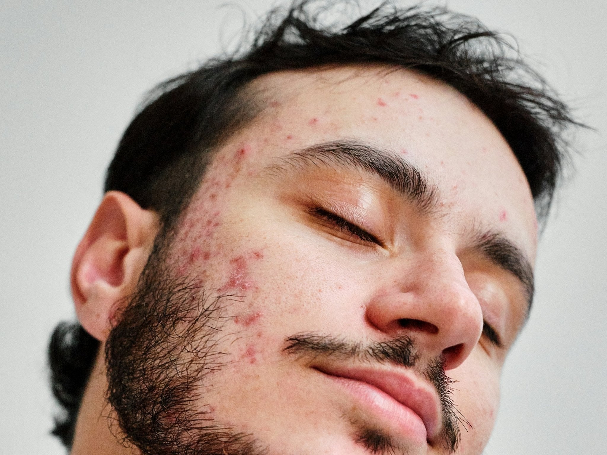 How to Identify Fungal Skin Overgrowths - Skynbio Skincare