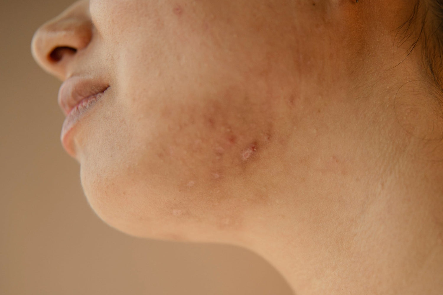 Sensitive Skin vs. Fungal Acne: What’s the Difference? - Skynbio Skincare