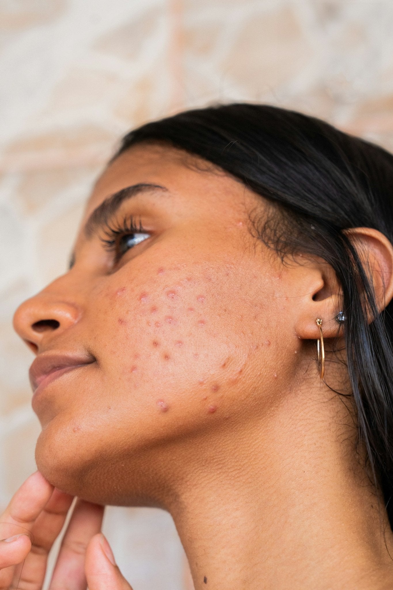 What's Really Happening When Your Skin 'Purges' - Skynbio Skincare