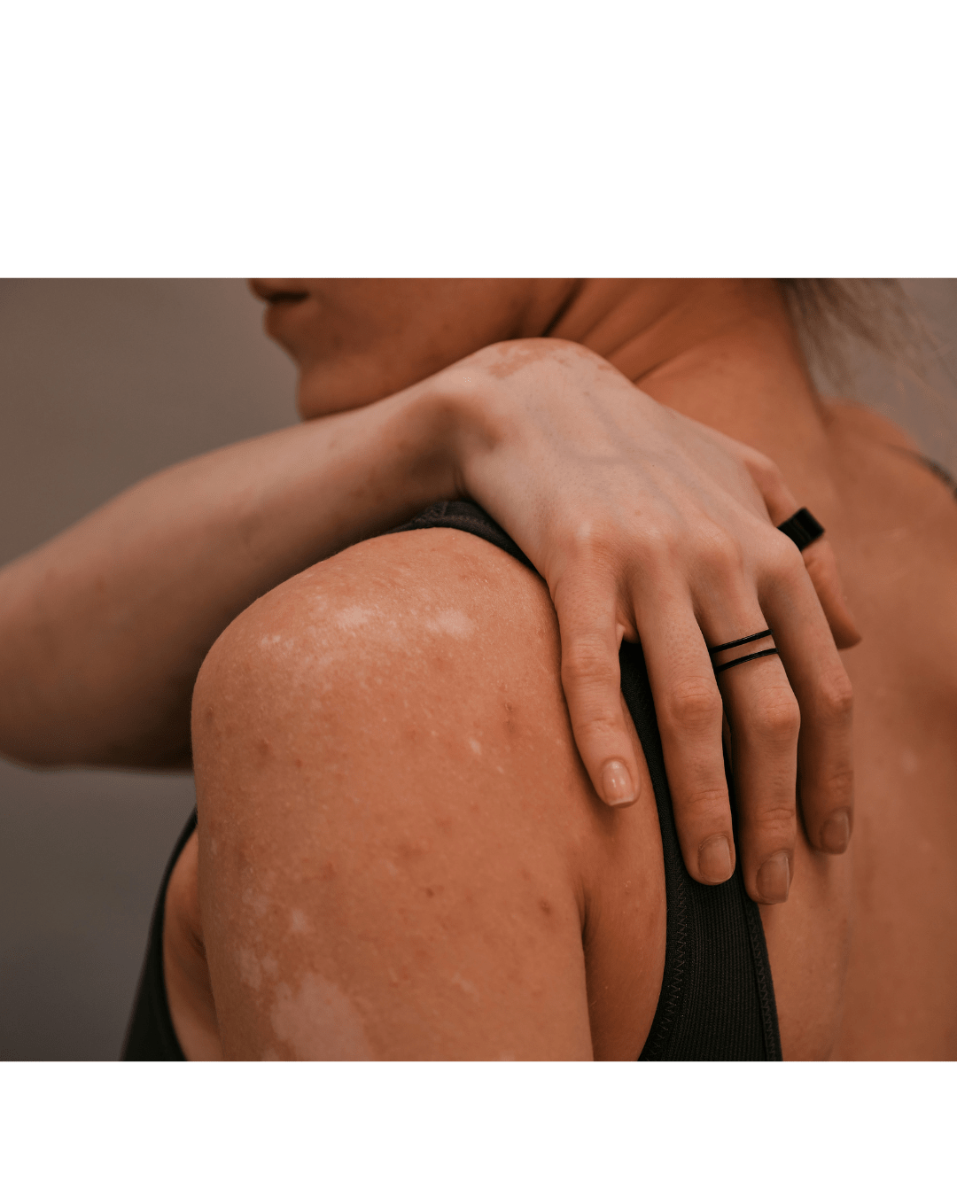 When Antifungal Treatments Work Too Fast: The Hidden Clue to Misdiagnosed Skin Issues - Skynbio Skincare