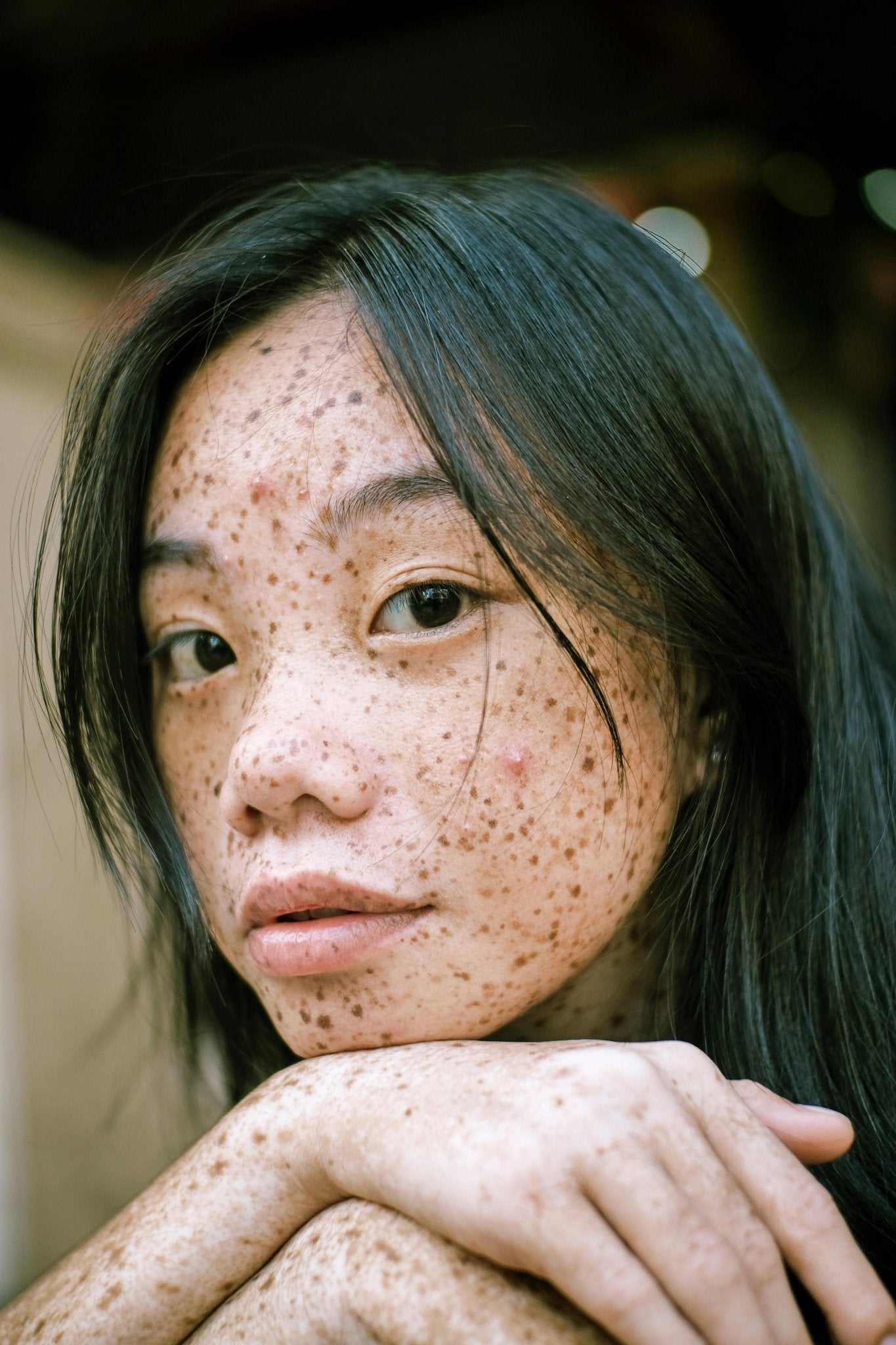 Why Your Fungal Acne Flare-Ups Keep Getting Worse....and How to Stop Them - Skynbio Skincare